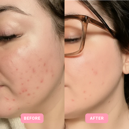 LUNA™ RADIANCEWAVE HIGH FREQUENCY FACIAL WAND