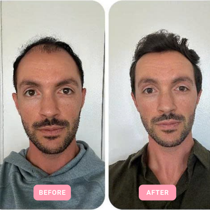 LUNA™ RADIANCEWAVE HIGH FREQUENCY FACIAL WAND